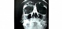 Hitler'in kafatası röntgeni açık artırmada